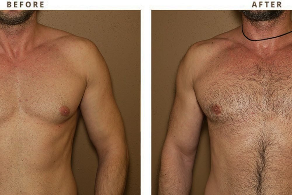 Gynecomastia-Correction-72