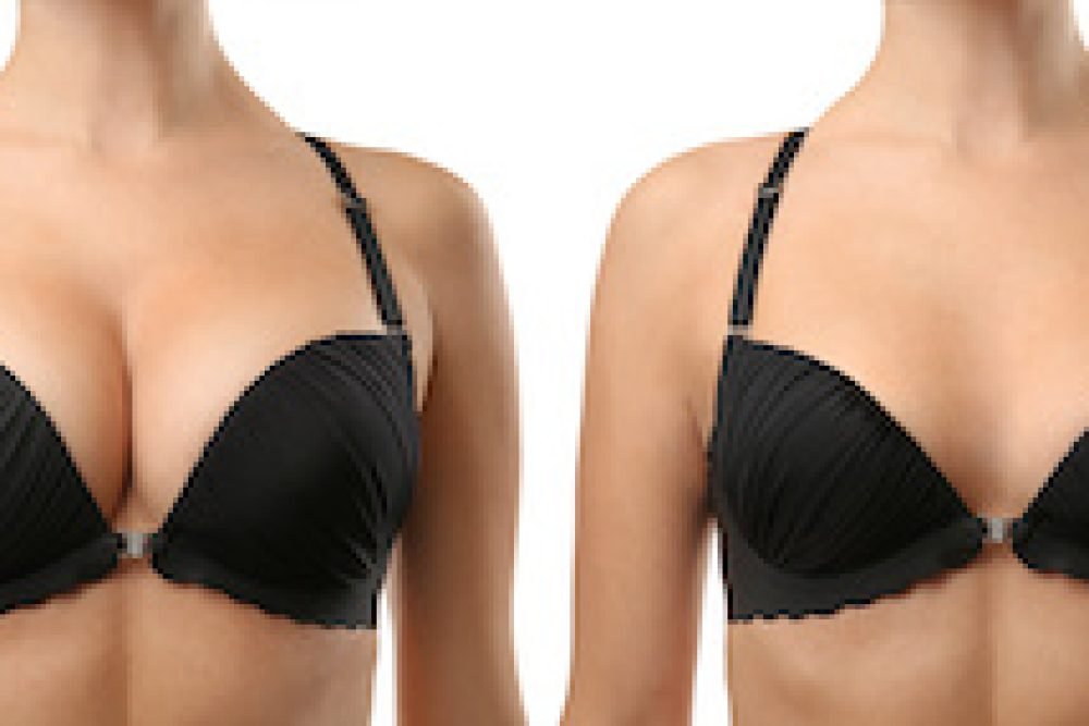 Woman before and after breast size correction on white background. Plastic surgery concept