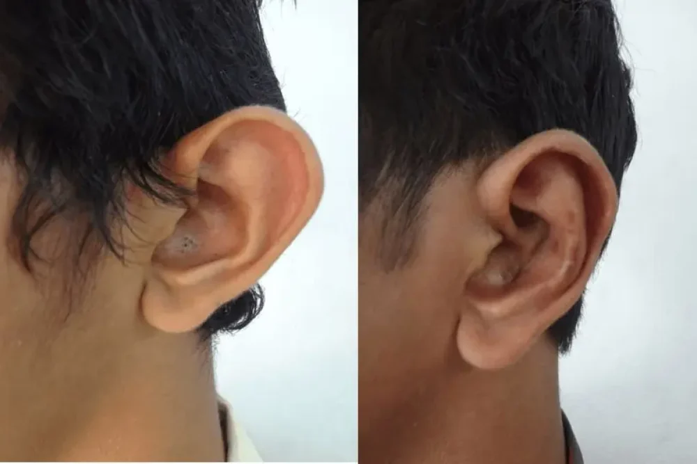 best-otoplasty-surgery-in-india