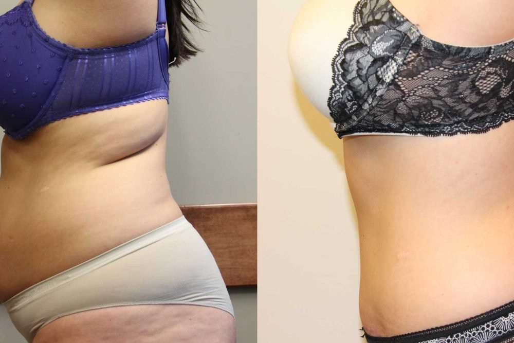 tummy-tuck-16472-before-after-02